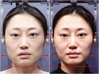 さつま骨格矯正 HRD広尾 西麻布院 /歪み小顔矯正 BeforeAfter