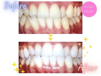 エクシアホワイトニング 心斎橋店/ホワイトニングビフォーアフター
