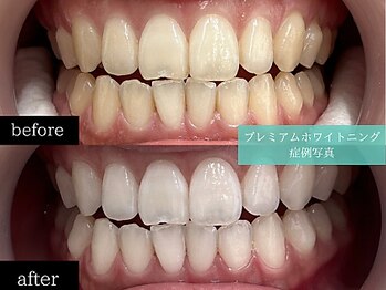 ホワイトニングカフェ 博多駅前店(WhiteningCafe)/◎歯のホワイトニング施術写真◎