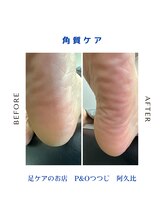 ピーアンドオー(P&O)/角質ケア