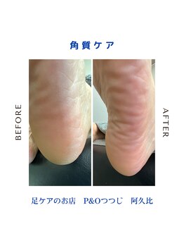 ピーアンドオー(P&O)/角質ケア