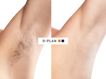 ディープラン 日進店(D∞PLAN)/経験者が驚く！ディープラン脱毛