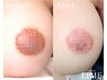 《最安値》期間限定価格【ローマピンク＊脇or乳輪】220000円→128000円