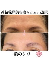 ケンビラク(Kenbiraku 健美楽)/額のシワ　1週間