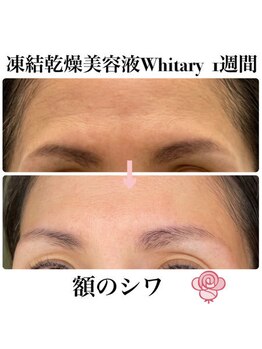 ケンビラク(Kenbiraku 健美楽)/額のシワ　1週間