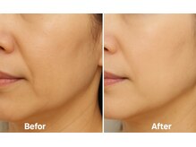 マロン(MARON)/ラミネーションピール