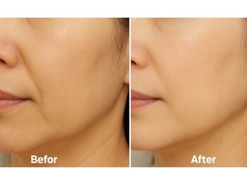 マロン(MARON)/ラミネーションピール