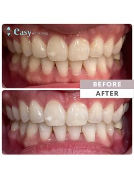 イージーホワイトニング 中野店(easy whitening)/セルフホワイトニング症例写真