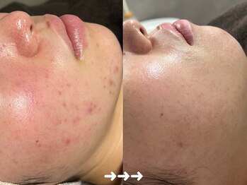 フローラスキン 恵比寿Amour店(florasKIN)/肌質改善(水光注入)