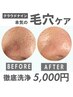 ≪肌全改善★ハイドロスキン≫顔全体をごっそり毛穴洗浄◎ ¥5.000