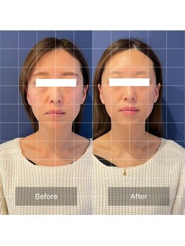 フフラ KANコルギセラピー山梨本店(fufla)/コルギ　小顔ソムリエ