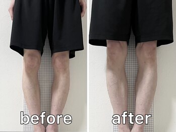 サンク(Cinq)/【骨盤矯正+O脚矯正】O脚改善