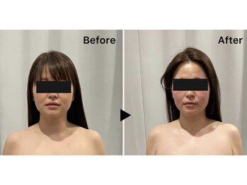 レミュー(Les mieux)/パッと印象が変わる驚きの小顔術