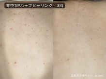 ジュパール(je pars)/背中TIPハーブピーリング