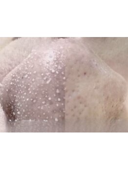 毛穴ケアをしたい