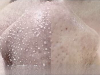 ロココ(ROCOCO)の写真/韓国式3D毛穴洗浄でお肌に優しくケア!毛穴専用パックでスッキリ美肌を手に入れましょう。