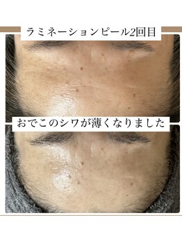 陽月 鍼灸院整骨院/ラミネーションピール2回目