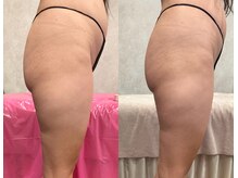 ブリア 横浜(BRILLA)/DETOXソルトでリンパマッサージ