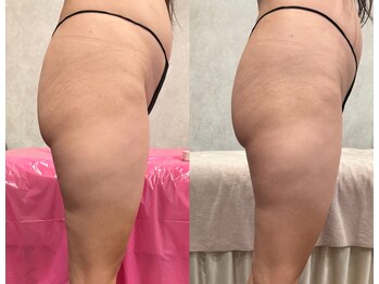 ブリア 横浜(BRILLA)/DETOXソルトでリンパマッサージ