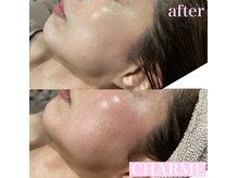 【リアボーテエステ】お肌悩みを根本から改善し素肌に自信を！