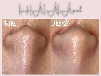 美シェリ(美Cheri)/ララピールビフォーアフター