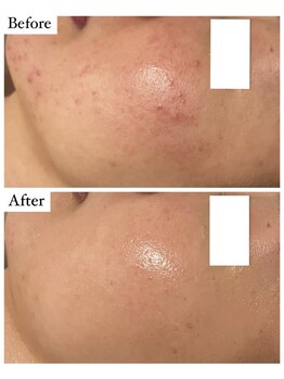 ベル 恵比寿(Belle)/REVI陶肌トリートメント/恵比寿