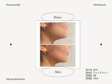 アンフェム(Anfem)/レモンボトル
