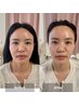 人気No.1【憧れの小顔に♪】顔+上半身全体リンパ◎コルギ以上の施術￥15800→