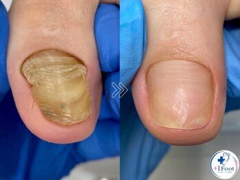 プラスワンフット 本厚木(+1 Foot)の写真/変形・肥厚した爪を正常な爪へ。爪の形が悪い/爪の色が気になるなど足や爪のお悩みを一緒に解決しましょう!