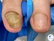 プラスワンフット 本厚木(+1 Foot)の写真/変形・肥厚した爪を正常な爪へ。爪の形が悪い/爪の色が気になるなど足や爪のお悩みを一緒に解決しましょう!