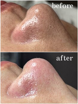 ティーツリー 名古屋 桜山(Tea Tree)/黒ずみの徹底除去