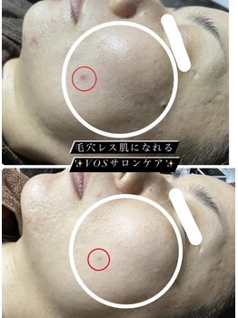アローナ(ARONA)/VOSサロンケアで本気の肌改善