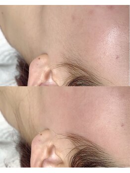 マルレ アイサロン 三軒茶屋(MARLE eyesalon)/もみあげ糸脱毛