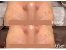 綺麗サロン 脱毛アンドフェイシャル ジュエル(Jewel)/【ポイントシミケア】