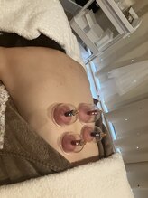 瑞 鍼灸院/オプションカッピング