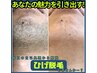 8月【平日限定】ヒゲ全体脱毛！髭剃りのない毎日へ！