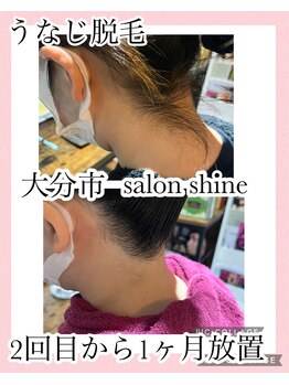 サロンシャイン(Salon Shine)/うなじ脱毛