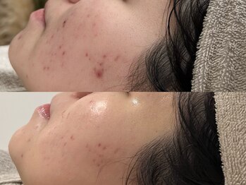 ピブ(PIBU)/ニキビ症例/ハーブピーリング