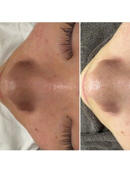 骨盤ダイエットサロン カンフリエ(camphrier)/毛穴洗浄×ハーブピーリング