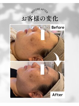エムボーテ 太田店(M BEAUTE33)/顔筋小顔コルギ