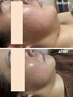 【地域最安特別価格】人気No.1 脂肪燃焼剤導入×肌質再生ケア/90分