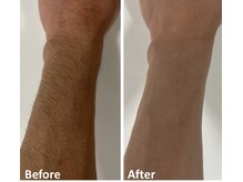 コンフィデンスサロン(Confidence Salon)/メンズ腕脱毛★