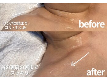 キュー(cue)/光フェイシャルデコルテ1回目