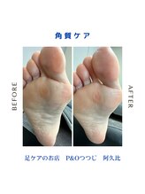ピーアンドオー(P&O)/角質ケア