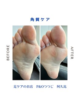 ピーアンドオー(P&O)/角質ケア