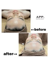 アプ(APP.)/シェービング/ピーリング/脱毛/