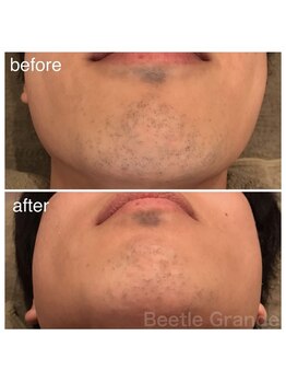 ビューティーモール(BEAUTY MALL)/男性ヒゲ脱毛1回施術