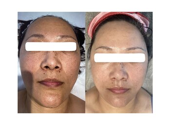 Nビューティー/最新RFサーモシェイプオーパス