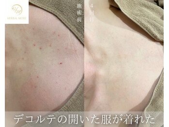 ウルワシ(Uruwashi)/ハーバルモアハーブピーリング