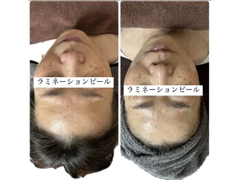 陽月 鍼灸院整骨院/ラミネーションピール